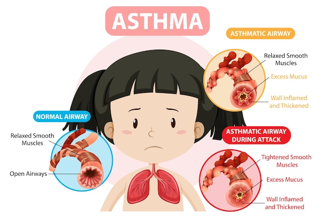 Free Vector Asthma Diagram With Normal Airway And Asthmatic Airway