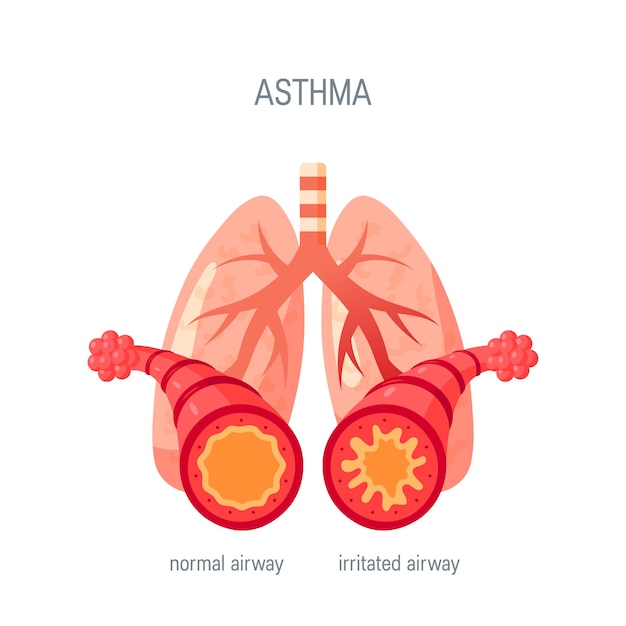 Premium Vector | Asthma disease concept. in flat style for medical ...