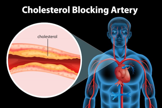 Ateriosclerosis medical condition Free Vector