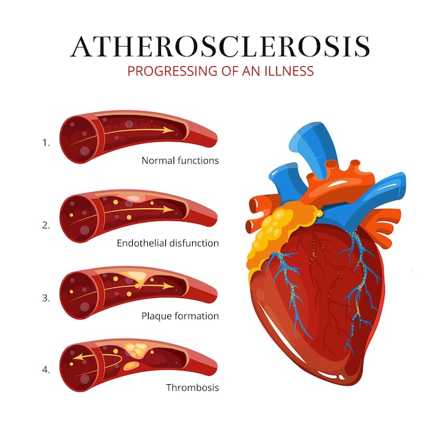 アテローム性動脈硬化症 血栓形成 ベクトル医学のイラスト 内臓器官 血栓症およびe プレミアムベクター