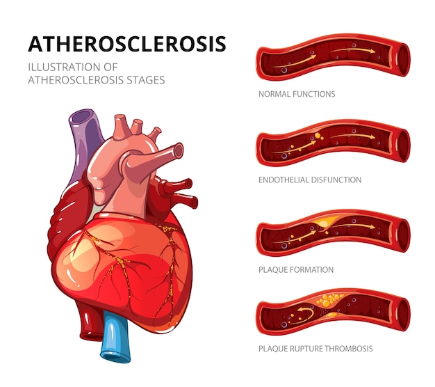 Free Vector Atherosclerosis. fibrous plaque formation. medical human