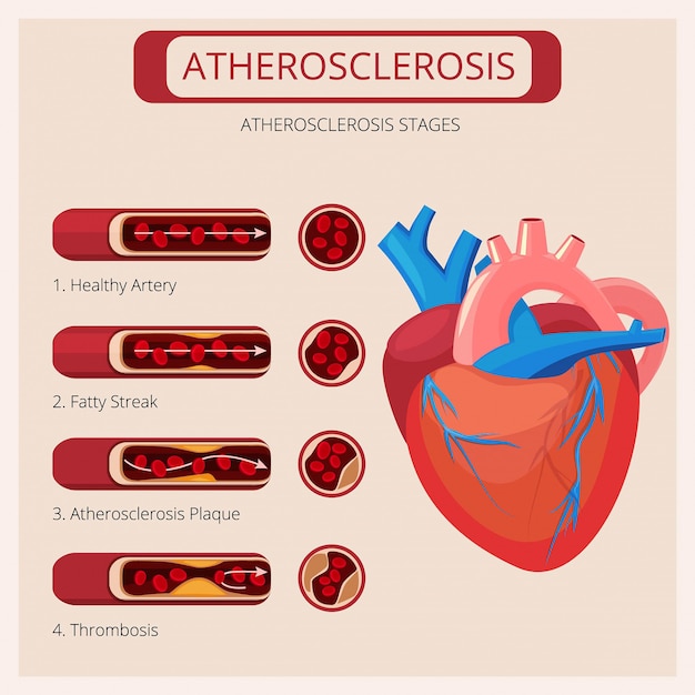 Atherosclerosis System Disorder Template