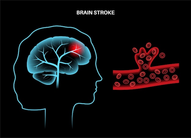 Premium Vector | Brain stroke hemorrhagic