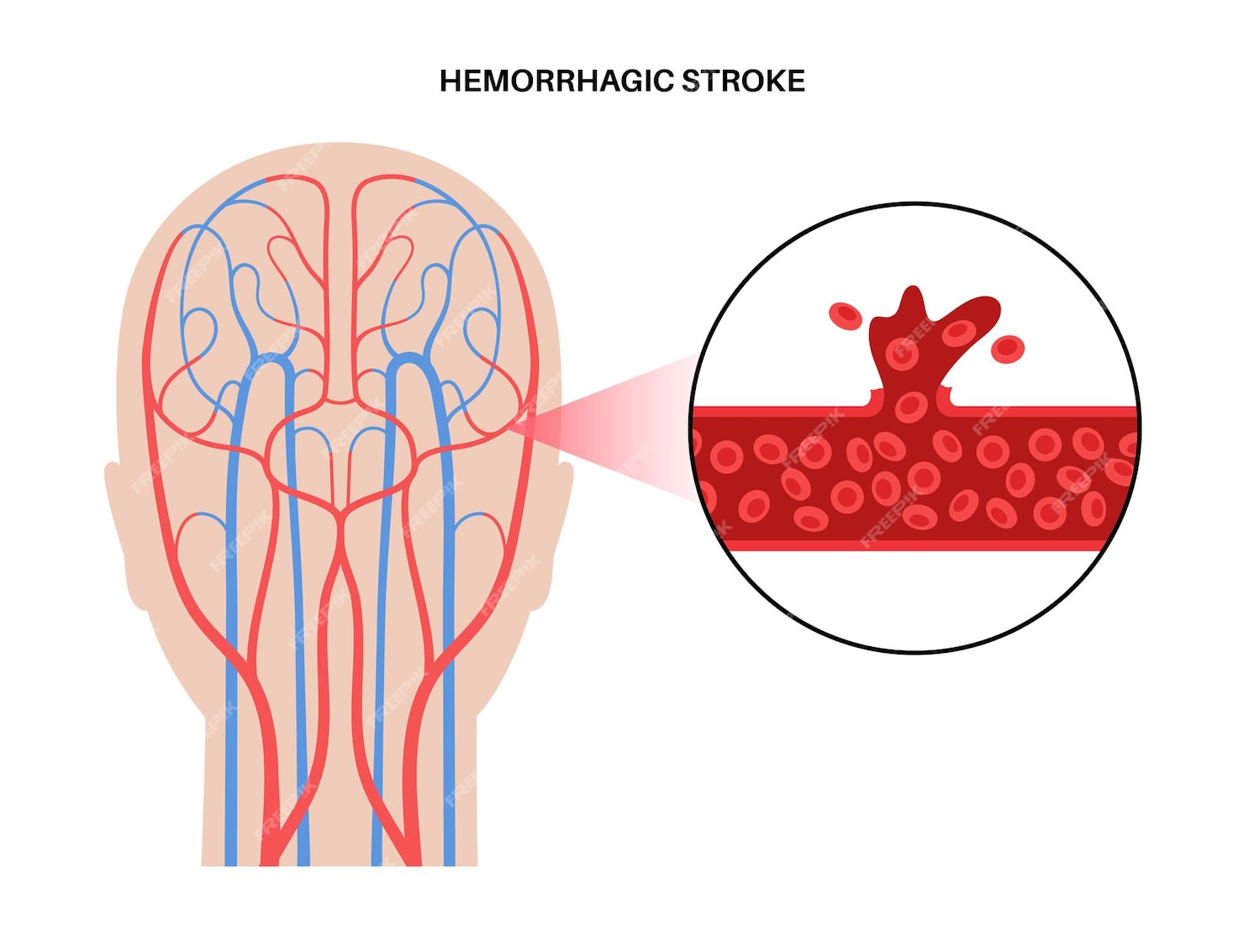 Premium Vector | Brain stroke hemorrhagic