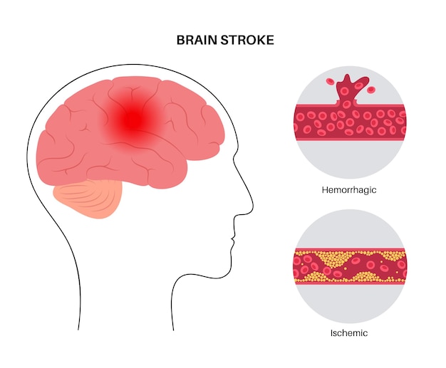 Premium Vector Brain Stroke Ishemic And Hemorrhagic 1972