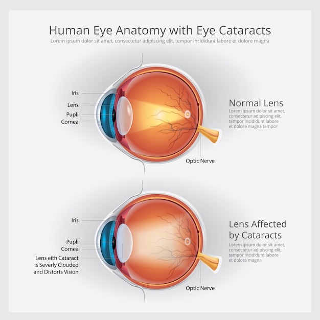 白内障の視力障害および正常な眼球の解剖学のイラスト プレミアムベクター