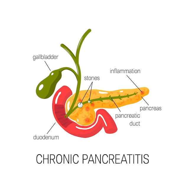 Premium Vector Chronic Pancreatitis Concept Medical Of Inflamed Pancreas In Cross Section 1945