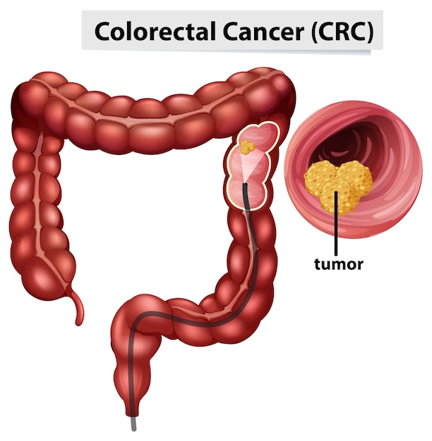 教育のための大腸がん Crc インフォグラフィック 無料のベクター