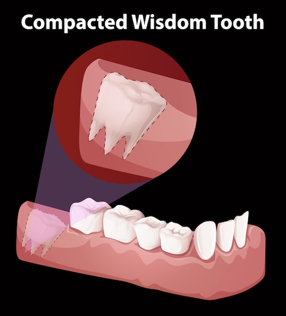 Compacted wisdom tooth diagram Vector Premium Download