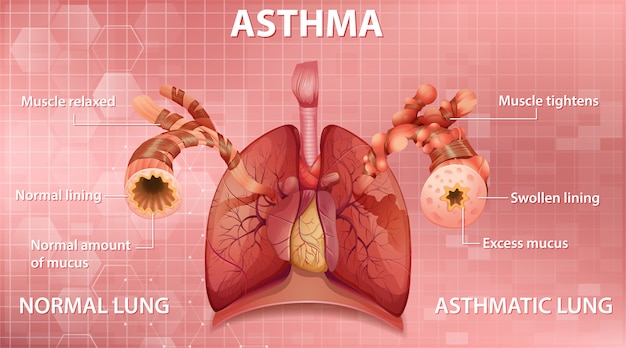 Free Vector | Comparison of healthy lung and asthmatic lung