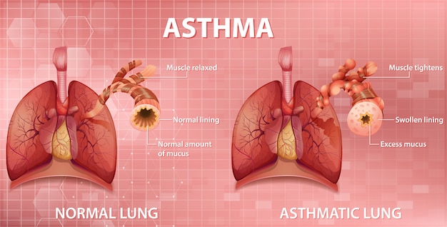 Free Vector | Comparison of healthy lung and asthmatic lung