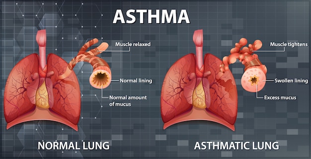 Asthma Lungs X Ray