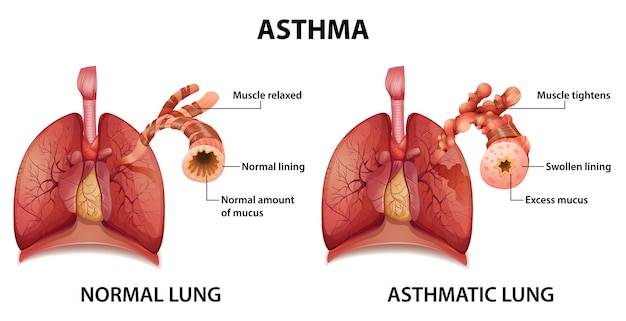 free-vector-comparison-of-healthy-lung-and-asthmatic-lung