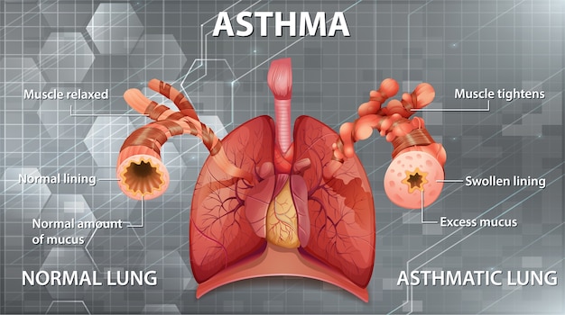 Free Vector Comparison Of Healthy Lung And Asthmatic Lung