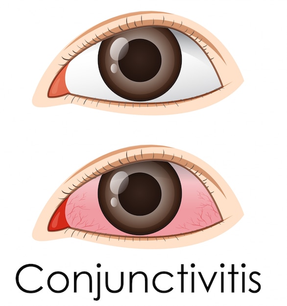 Premium Vector Conjunctivitis In Human Eyes 