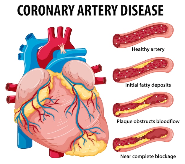 free-vector-coronary-artery-disease-for-health-education-infographic