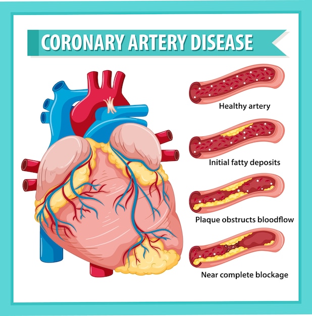 Free Vector | Coronary artery disease for health education infographic