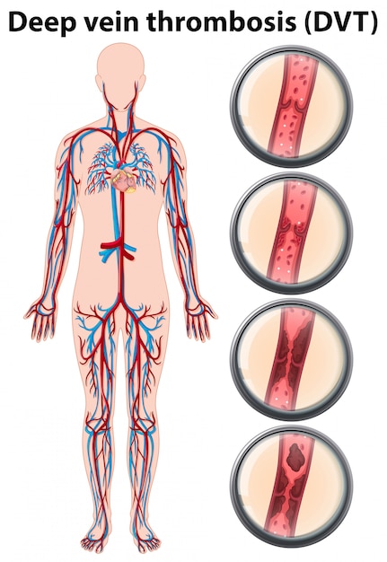 Deep Vein Thrombosis Anatomical Chart