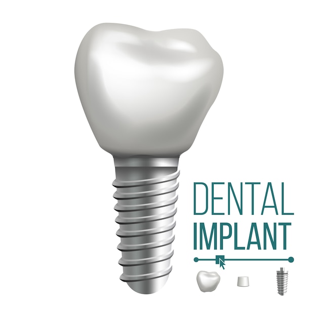 Premium Vector Dental Implant Illustration