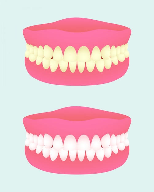 Dental Implant Color Chart