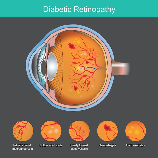 Premium Vector | Diabetic retinopathy illustration