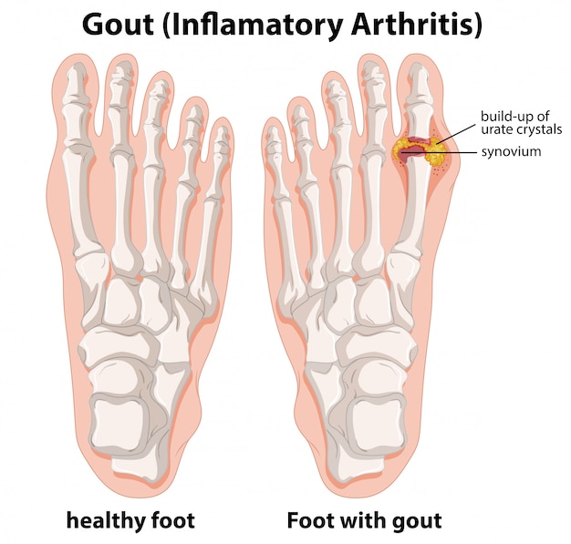 Diagram Explanation Of Gout In Human Foot