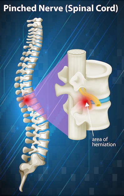 Premium Vector | Diagram of pinched nerve at spinal cord