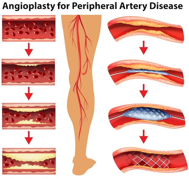 diagram-showing-angioplasty-for-peripheral-artery-disease-vector