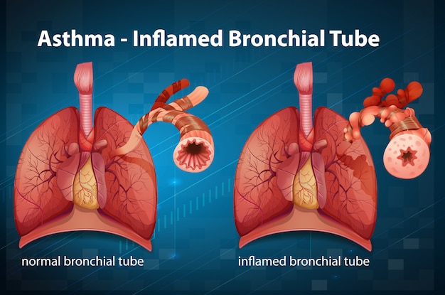 Diagram Showing Asthma Inflamed Bronchial Tube In Human Free Vector