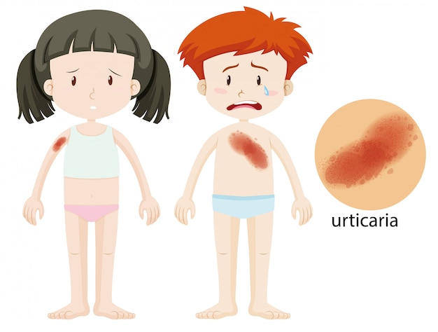 Free Vector | Diagram showing boy and girl with urticaria