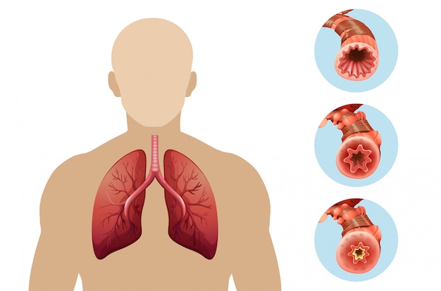 Free Vector | Diagram showing chronic obstructive pulmonary disease