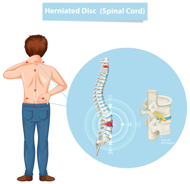 Free Vector Diagram Showing Herniated Disc