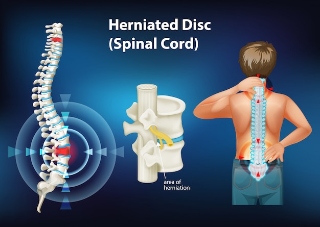 Free Vector | Diagram showing herniated disc