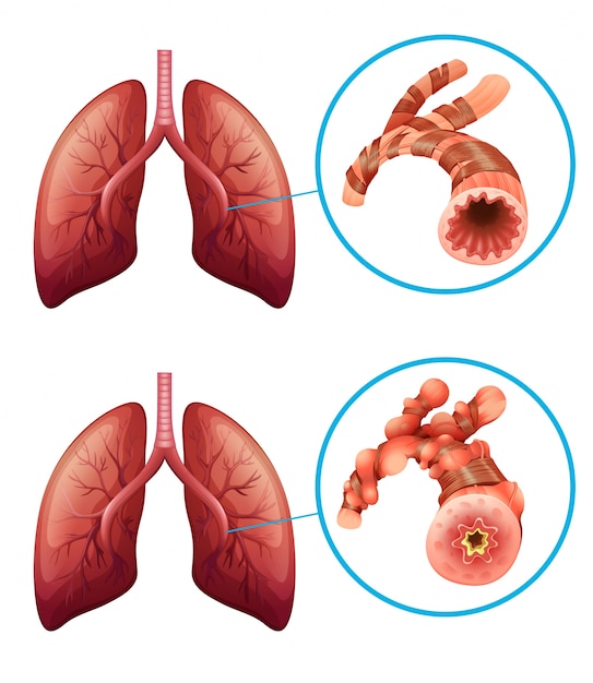 Premium Vector | Diagram showing lungs with disease