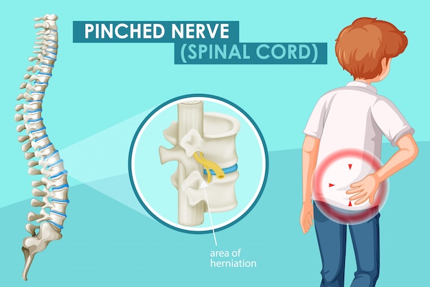 Free Vector | Diagram showing pinched nerve