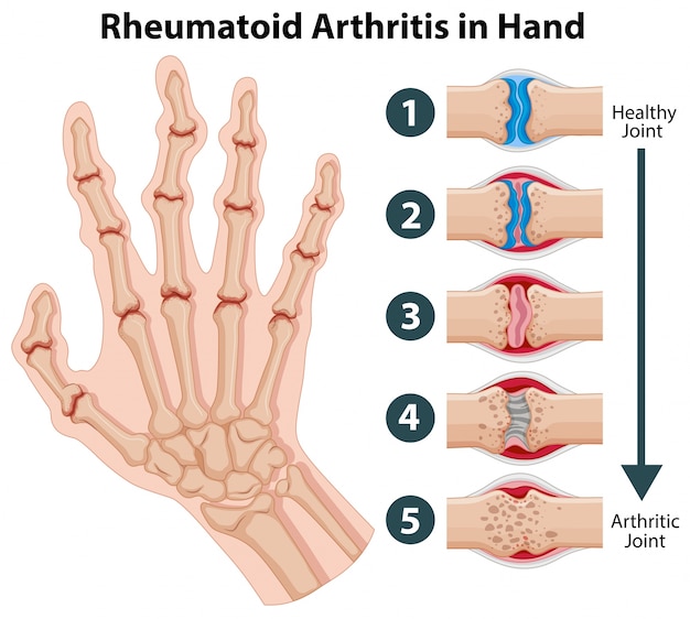 rheuma arthritis