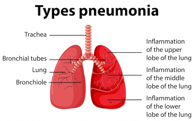 Premium Vector | Diagram showing types pneumonia