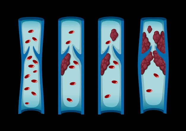 Different stages of blood clot in human Premium Vector