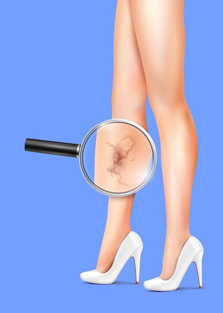 女性の足と静脈瘤のリアルなイラスト 無料のベクター