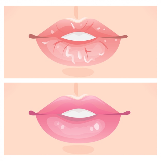 Download Free Flaky Lips And Beautiful Lips Vector Premium Download Use our free logo maker to create a logo and build your brand. Put your logo on business cards, promotional products, or your website for brand visibility.