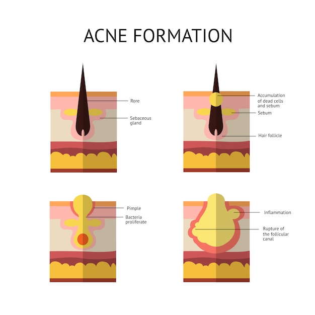 Premium Vector | Formation of skin acne or pimple. the sebum in the ...