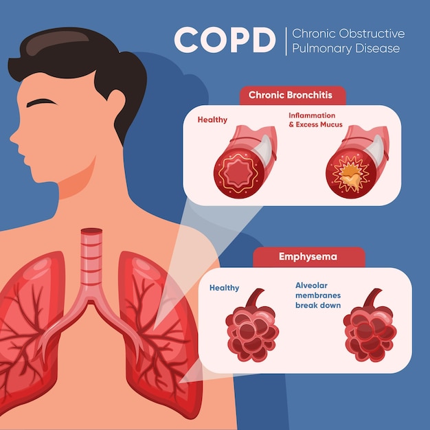Free Vector | Hand drawn copd infographic with illustrations