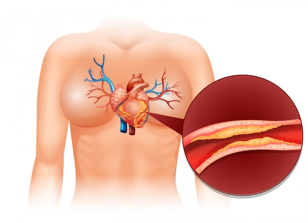 cardio vascular disease