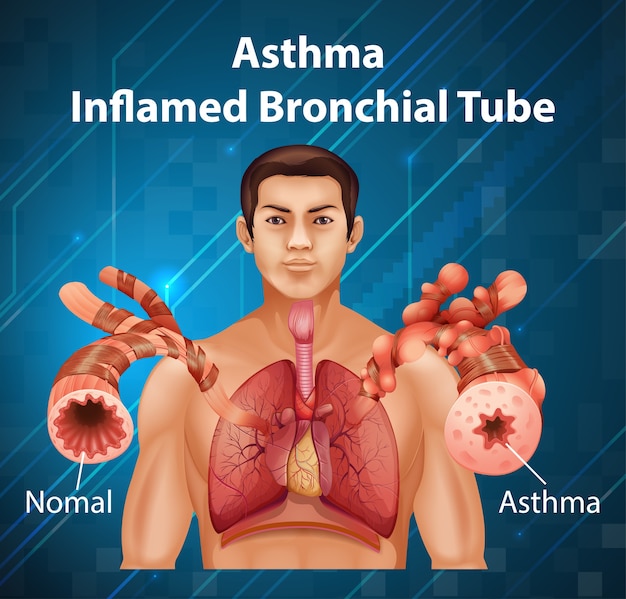人体解剖学喘息炎症性気管支図 無料のベクター