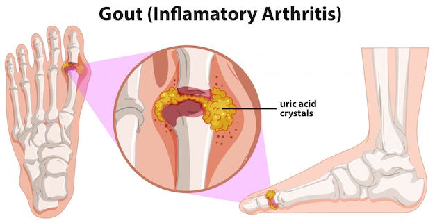 Arthritis