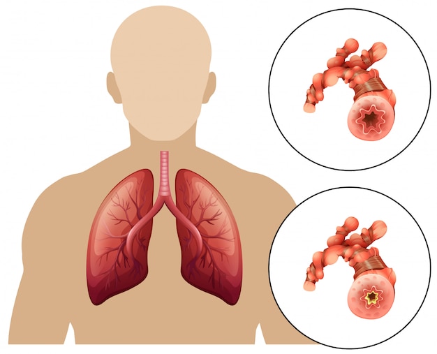 Human chronic obstructive pulmonary disease Premium Vector