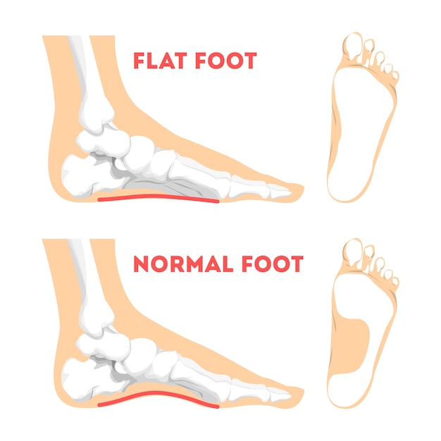 Premium Vector | Human foot pathology. flat foot anatomy