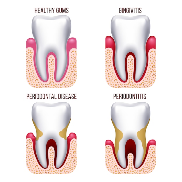 Premium Vector Human Gum Disease Gums Bleeding Tooth Disease