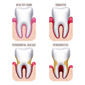 Premium Vector | Human gum disease, gums bleeding. tooth disease ...