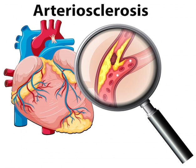 Free Vector | Human heart and arteriosclerosis